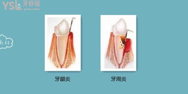 牙齒爛掉了只剩牙根怎么辦 是什么原因造成的啊