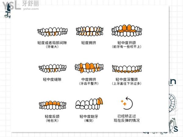 easysmile輕松笑隱形牙套適用9種牙齒畸形狀態(tài)