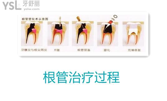 根管治療