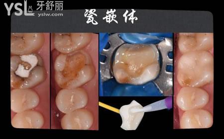 補牙容易脫落 哪種耐用不容易掉 補牙的材料該怎么選擇 .jpg