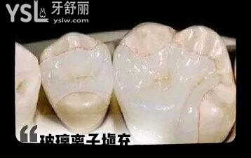 補牙容易脫落 哪種耐用不容易掉 補牙的材料該怎么選擇 .jpg