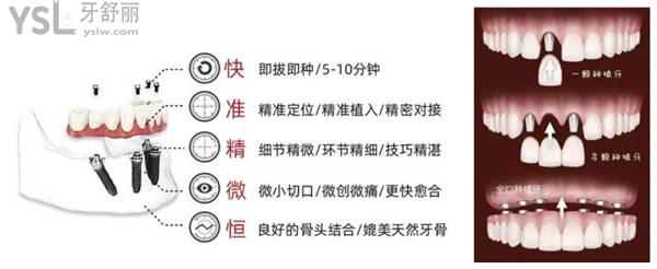 即刻負重種植牙優(yōu)勢