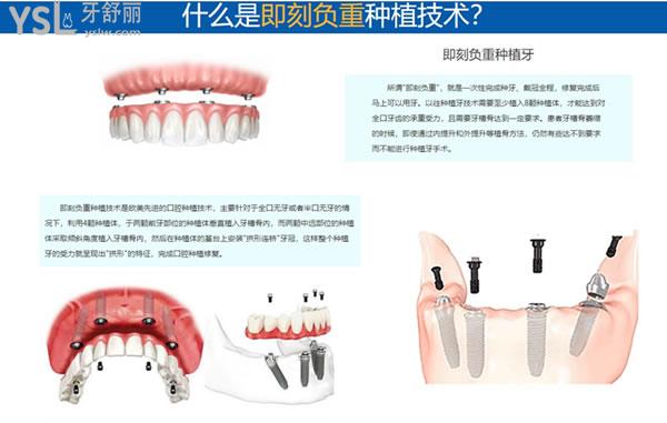 什么是即刻負重種植技術(shù)