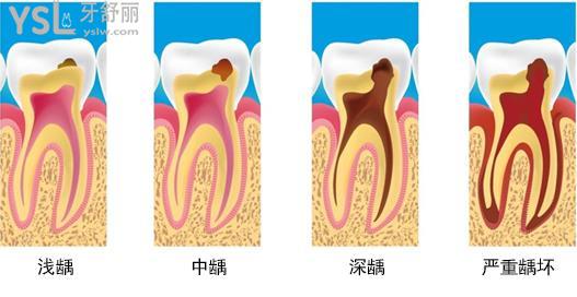 蛀牙程度