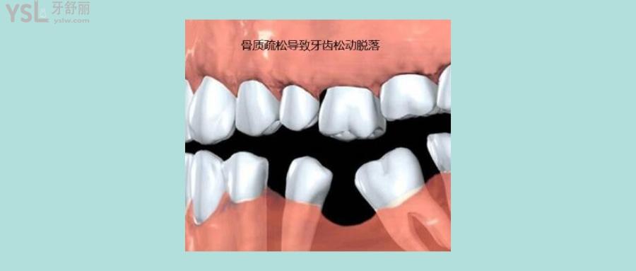 老年人牙齒脫落是什么原因引起的