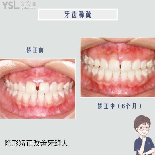 牙齒矯正改善牙縫