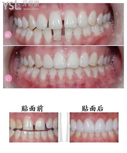 牙貼面改善牙縫對比圖