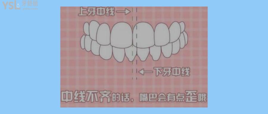 矯正牙齒中線不齊要緊嗎