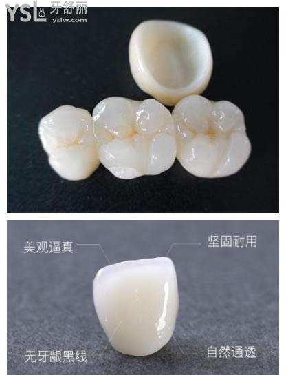 全瓷牙牙冠