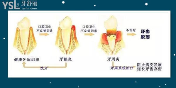 洗一次牙結(jié)石大概多少錢 牙結(jié)石不處理對身體有危害嗎.jpg