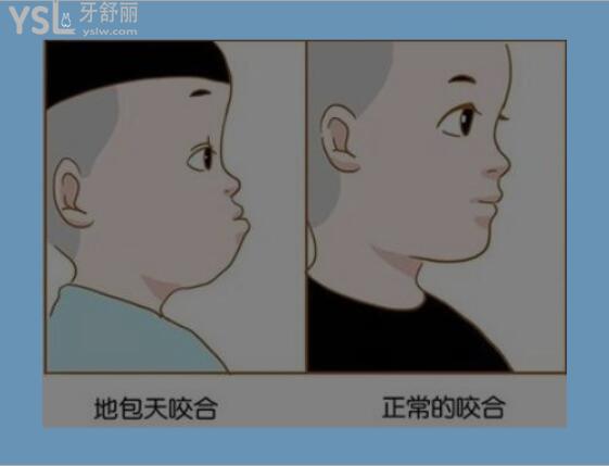 牙齒地包天有必要治嗎