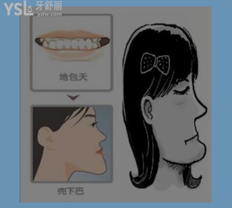 牙齒地包天有必要治嗎