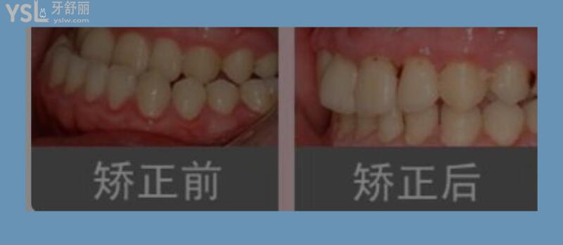 牙齒地包天有必要治嗎