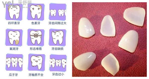 義獲嘉瓷貼面使用壽命