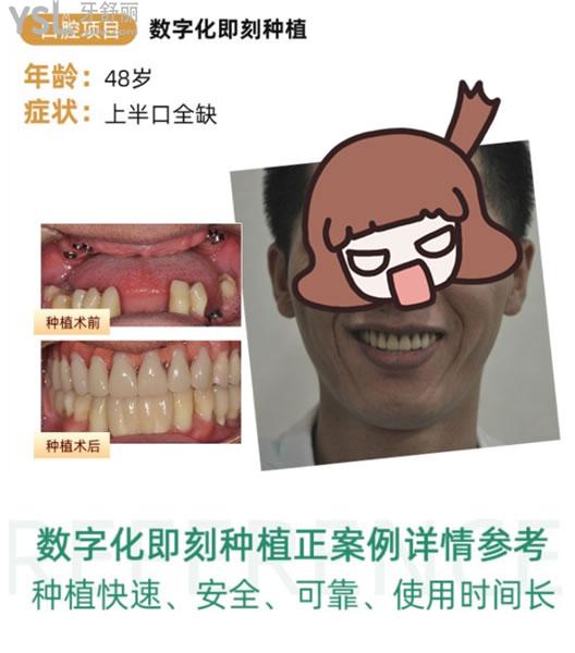 佛山雅度口腔上半口種植術(shù)后圖