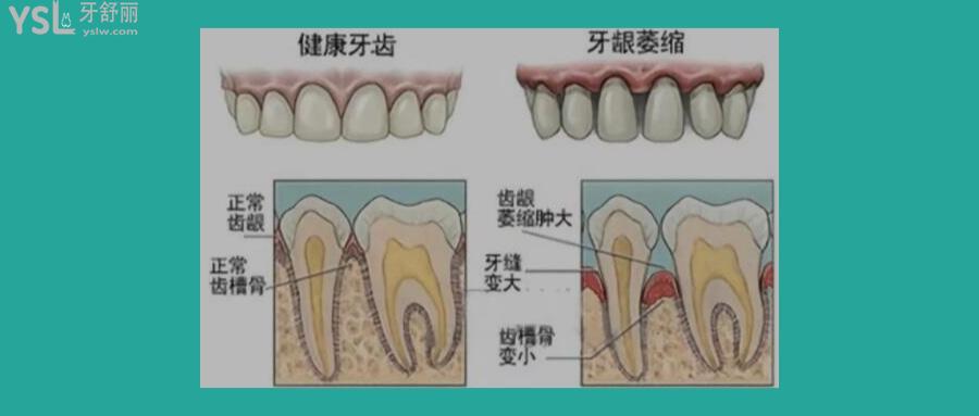 牙床萎縮怎么裝假牙