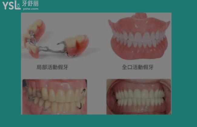 牙床萎縮怎么裝假牙