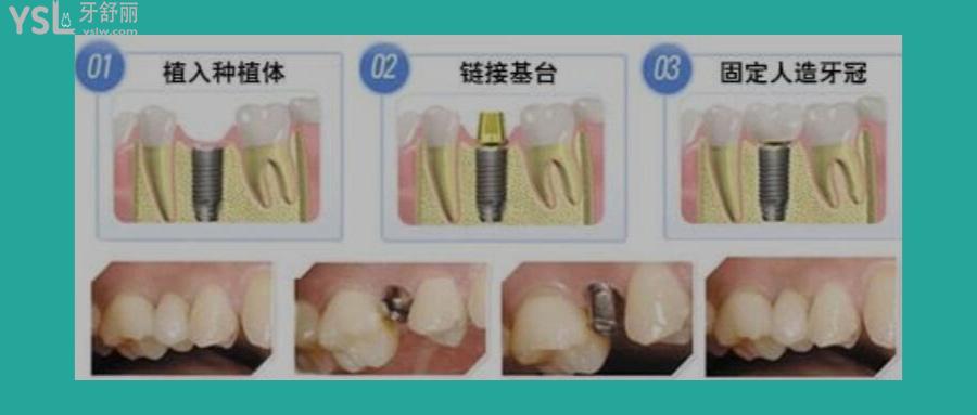 牙床萎縮怎么裝假牙