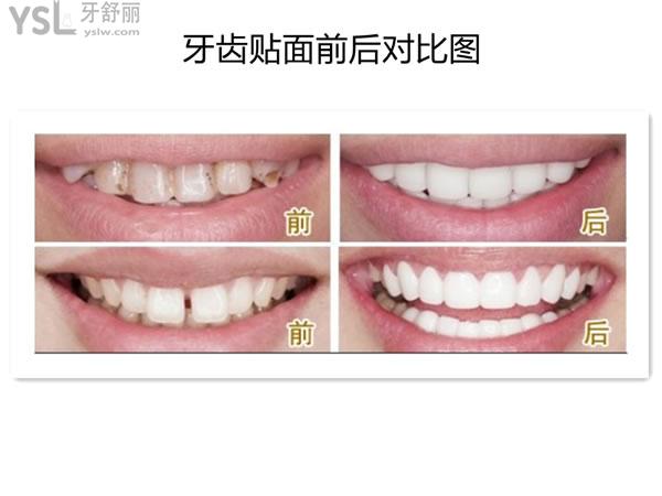 牙齒貼面前后對(duì)比圖