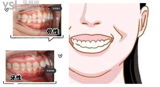 凸嘴可以用牙套矯正嗎