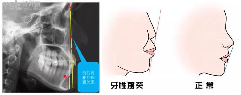 凸嘴可以用牙套矯正嗎