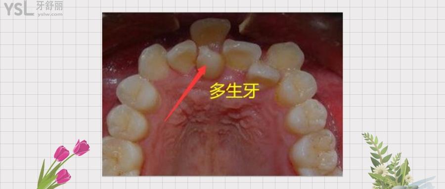 多生牙拔了多久長(zhǎng)新牙