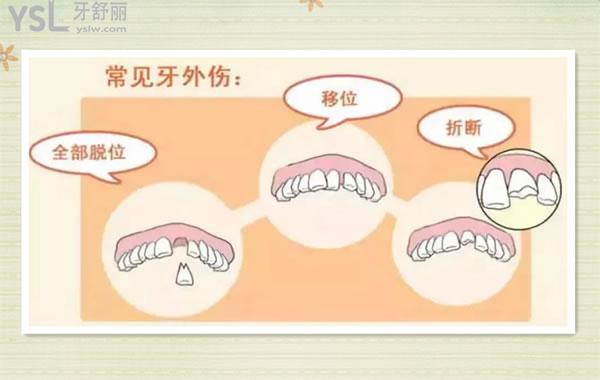 牙外傷的類型