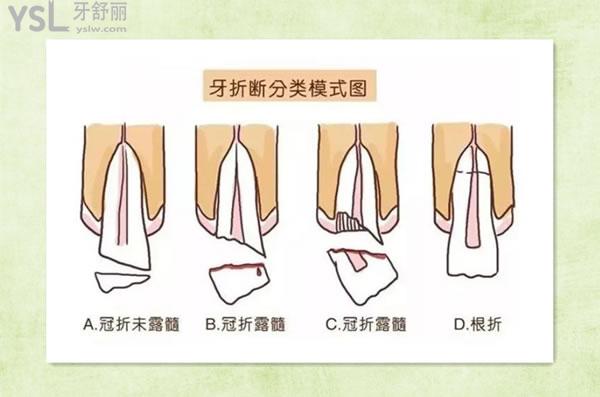 牙折斷分類
