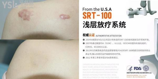 SRT100放療祛疤痕的費(fèi)用以及復(fù)發(fā)率怎么樣？