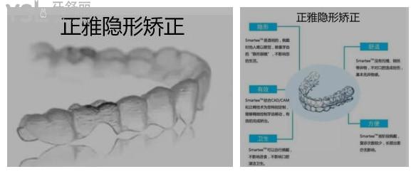 牙齒矯正隱形的什么品牌