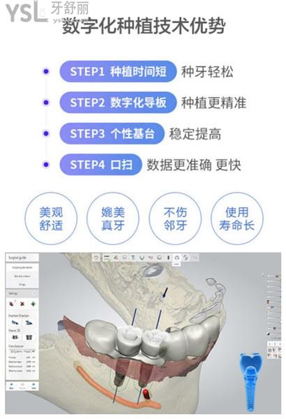 北京科爾口腔種植牙技術優(yōu)勢