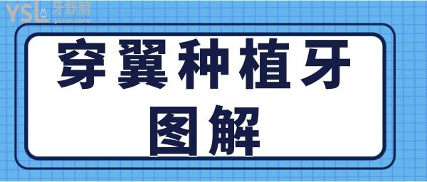 穿翼種植牙示意圖 穿翼種植牙風(fēng)險(xiǎn)