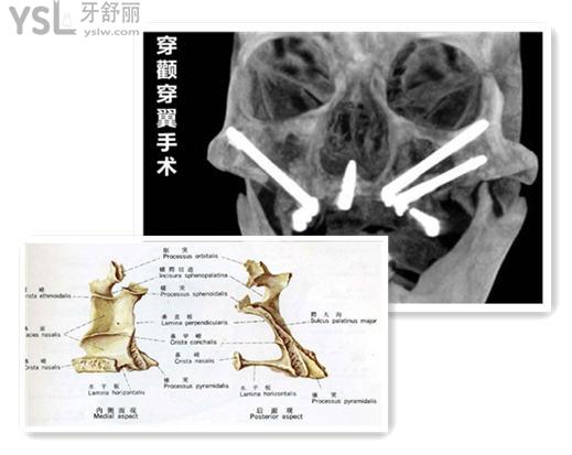 穿翼種植牙示意圖 穿翼種植牙風(fēng)險(xiǎn)
