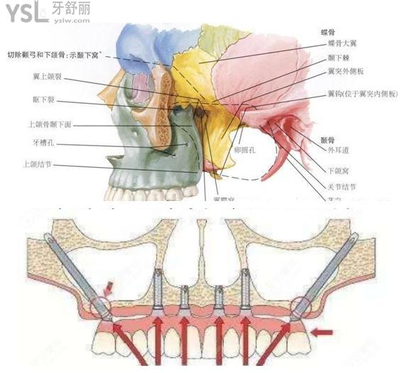 穿翼種植牙示意圖 穿翼種植牙風(fēng)險(xiǎn)