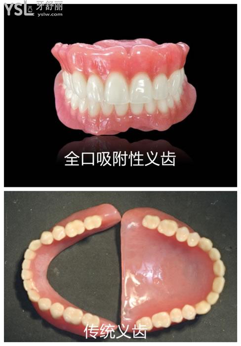 全口吸附性義齒和傳統(tǒng)義齒對(duì)比