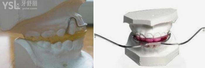 兒童下頜骨后縮矯正器圖片