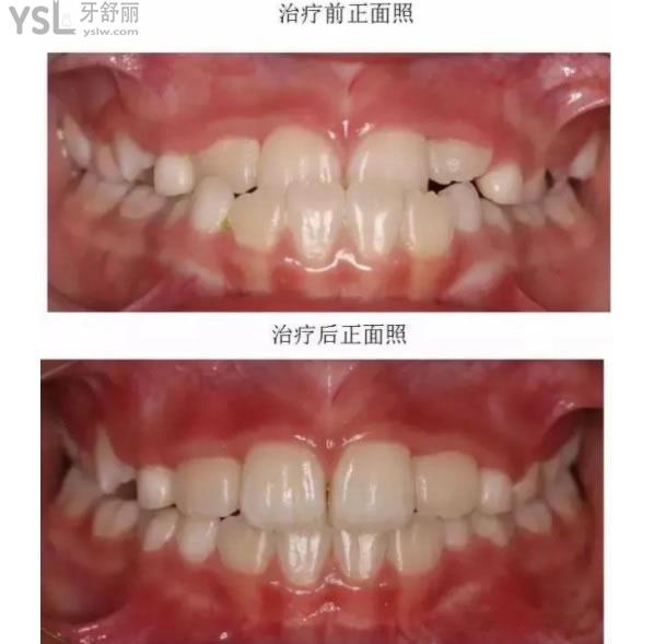 兒童牙齒畸形治療前后圖