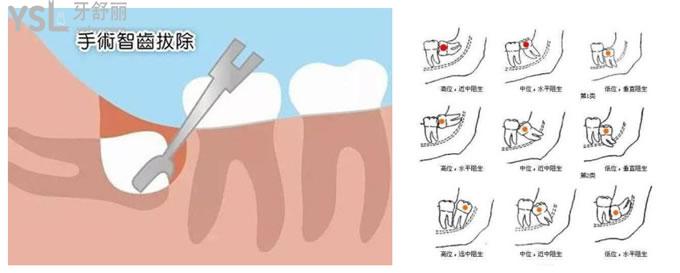 拔智齒