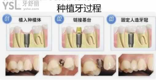 為什么會(huì)有人說(shuō)種植牙本身就是個(gè)騙局