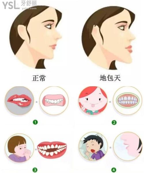 地包天牙齒矯正費用多少錢