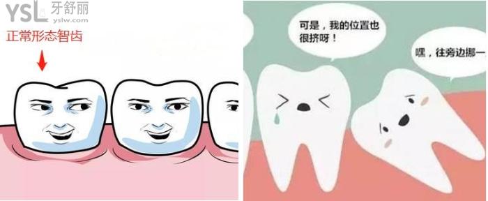 智齒長(zhǎng)歪一點(diǎn)要拔嗎.jpg