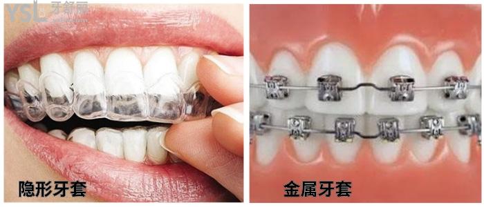 隱形牙套于金屬牙套對比.jpg