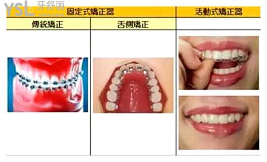 矯正器_副本.jpg