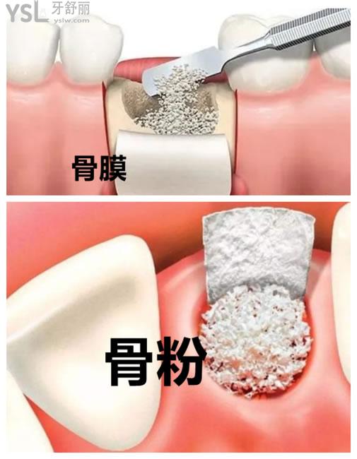 骨粉骨膜