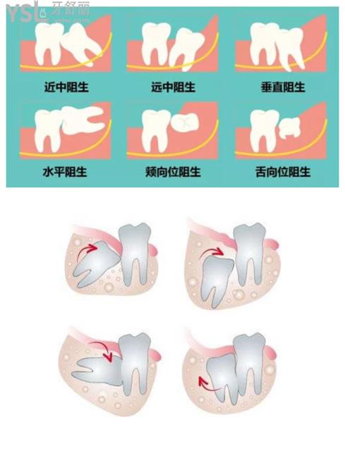 智齒類型圖