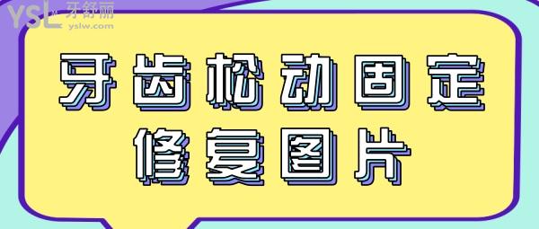 牙齒松動(dòng)固定修復(fù)圖片