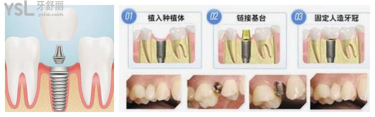 全口種植牙后悔了