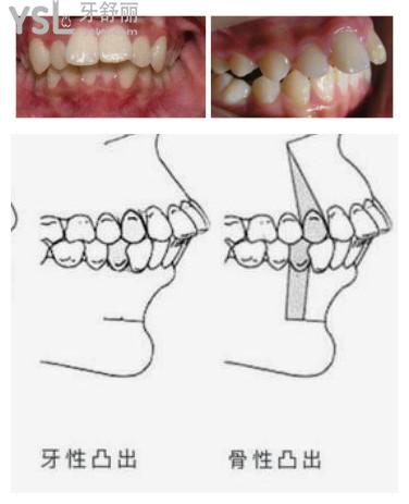 牙槽骨突出矯正方法