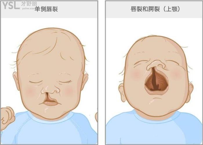 唇腭裂屬于什么遺傳?。?jpg