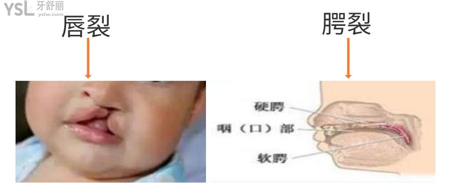 唇裂和腭裂哪個重